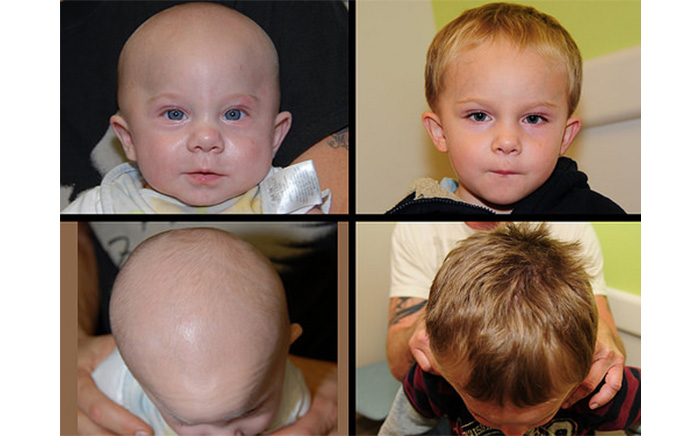 Open Craniosynostosis Repair Gallery | St. Louis Children's Hospital